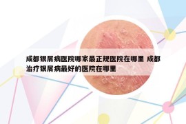 成都银屑病医院哪家最正规医院在哪里 成都治疗银屑病最好的医院在哪里