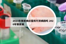 2023年银屑病还是找不到病因吗 2020年银屑病