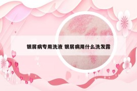 银屑病专用洗液 银屑病用什么洗发露