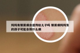 妈妈有银屑病会遗传给儿子吗 银屑病妈妈生的孩子可能会得什么病