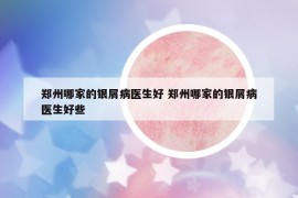 郑州哪家的银屑病医生好 郑州哪家的银屑病医生好些