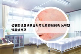 关节型银屑病已变形可以用抑制剂吗 关节型银屑病用药