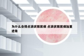 为什么会得点滴状银屑病 点滴状银屑病加重迹象