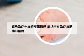 廊坊治疗牛皮癣哪里最好 廊坊市有治疗皮肤病的医院