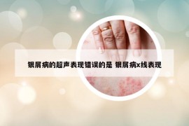 银屑病的超声表现错误的是 银屑病x线表现