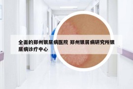 全面的郑州银屑病医院 郑州银屑病研究所银屑病诊疗中心