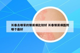 长春去哪家的银屑病比较好 长春银屑病医院哪个最好