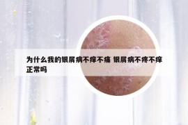 为什么我的银屑病不痒不痛 银屑病不疼不痒正常吗