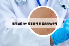 银屑病输克林霉素行吗 银屑病能输液吗