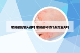 银屑病能输头孢吗 银屑病可以打点滴消炎吗