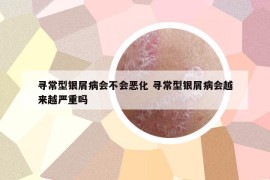 寻常型银屑病会不会恶化 寻常型银屑病会越来越严重吗