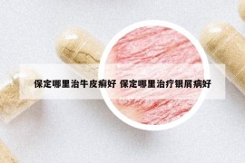 保定哪里治牛皮癣好 保定哪里治疗银屑病好