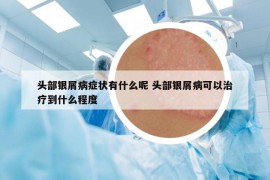 头部银屑病症状有什么呢 头部银屑病可以治疗到什么程度