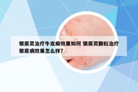 银屑灵治疗牛皮癣效果如何 银屑灵颗粒治疗银屑病效果怎么样?