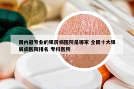 国内最专业的银屑病医院是哪家 全国十大银屑病医院排名 专科医院