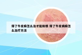 得了牛皮癣怎么治才能除根 得了牛皮病癣怎么治疗方法