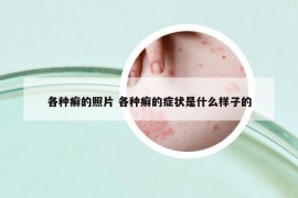 各种癣的照片 各种癣的症状是什么样子的