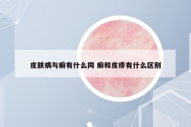 皮肤病与癣有什么同 癣和皮疹有什么区别