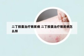 二丁胶囊治疗银屑病 二丁胶囊治疗银屑病怎么样