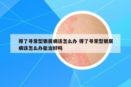 得了寻常型银屑病该怎么办 得了寻常型银屑病该怎么办能治好吗