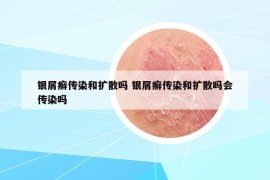 银屑癣传染和扩散吗 银屑癣传染和扩散吗会传染吗