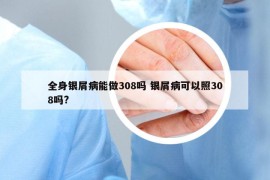 全身银屑病能做308吗 银屑病可以照308吗?