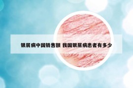 银屑病中国销售额 我国银屑病患者有多少