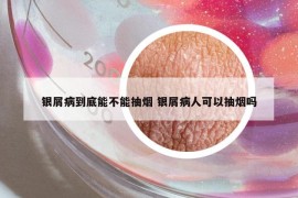 银屑病到底能不能抽烟 银屑病人可以抽烟吗