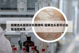 硫磺洗头膏可以长期用吗 硫磺洗头膏可以治脂溢性脱发