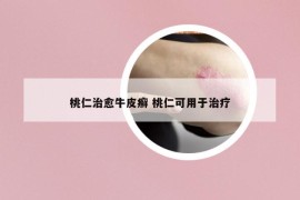 桃仁治愈牛皮癣 桃仁可用于治疗