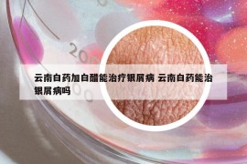 云南白药加白醋能治疗银屑病 云南白药能治银屑病吗