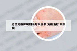 进口免疫抑制剂治疗银屑病 免疫治疗 银屑病