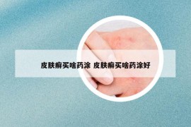 皮肤癣买啥药涂 皮肤癣买啥药涂好