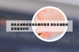 黑色素细胞修复液白癜风香港 黑色素细胞修复液是真的吗