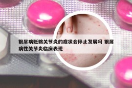 银屑病骶髂关节炎的症状会停止发展吗 银屑病性关节炎临床表现