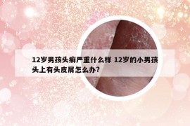 12岁男孩头癣严重什么样 12岁的小男孩头上有头皮屑怎么办?