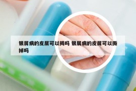 银屑病的皮屑可以揭吗 银屑病的皮屑可以撕掉吗