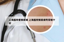 上海医院看银屑病 上海医院银屑病专家哪个好