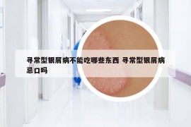 寻常型银屑病不能吃哪些东西 寻常型银屑病忌口吗