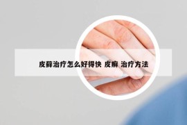 皮藓治疗怎么好得快 皮癣 治疗方法