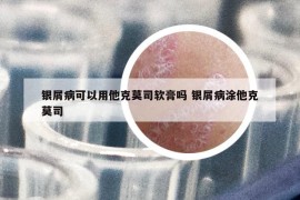 银屑病可以用他克莫司软膏吗 银屑病涂他克莫司