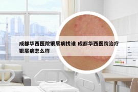 成都华西医院银屑病找谁 成都华西医院治疗银屑病怎么样