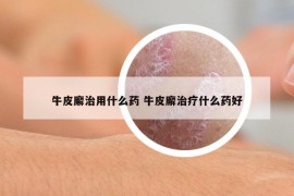 牛皮廨治用什么药 牛皮廨治疗什么药好