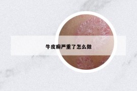 牛皮癣严重了怎么做