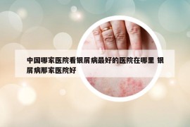 中国哪家医院看银屑病最好的医院在哪里 银屑病那家医院好