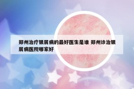 郑州治疗银屑病的最好医生是谁 郑州诊治银屑病医院哪家好