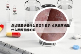 点状银屑病是什么原因引起的 点状银屑病是什么原因引起的呢