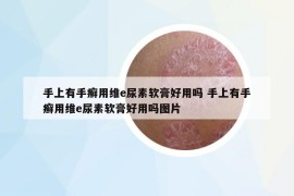 手上有手癣用维e尿素软膏好用吗 手上有手癣用维e尿素软膏好用吗图片