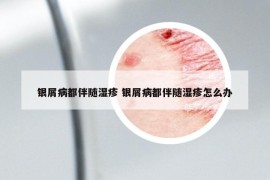 银屑病都伴随湿疹 银屑病都伴随湿疹怎么办