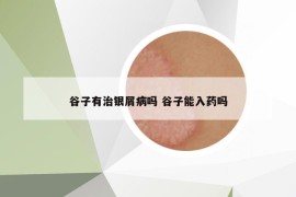 谷子有治银屑病吗 谷子能入药吗